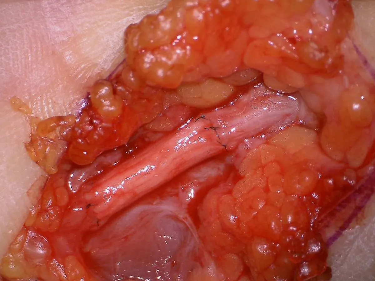 Concept of microsurgical nerve repair
