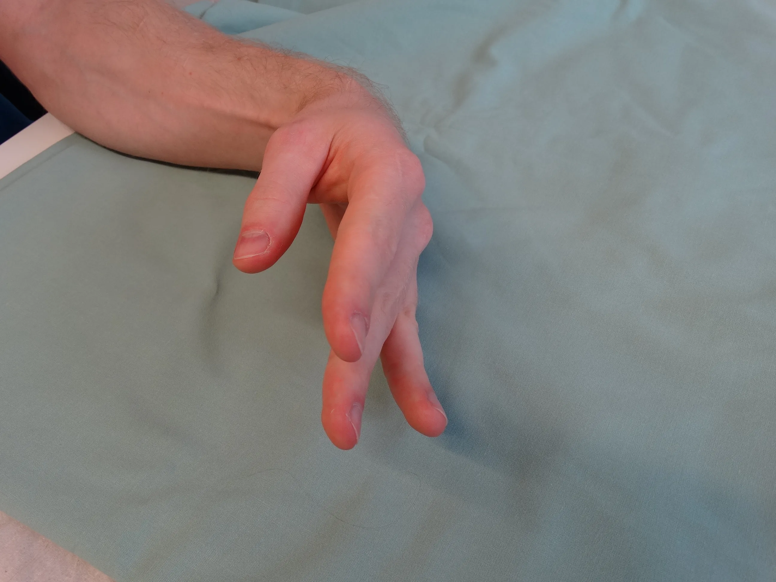 Medical illustration or clinical photo of a wrist drop symptom in radial nerve palsy